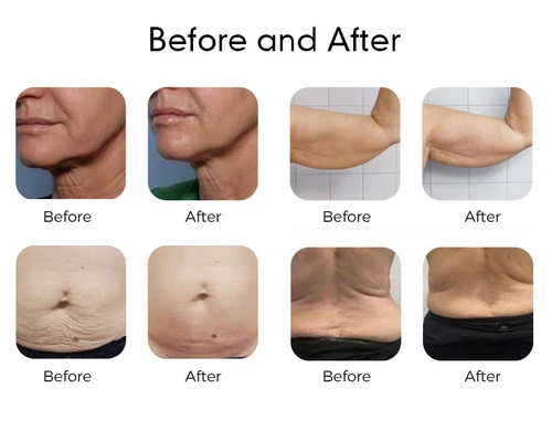 Microwave slimming machine reviews Microwave slimming machine reviews